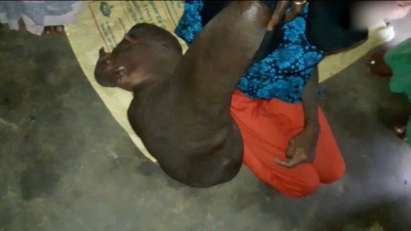 В Индии девушка с 10-килограммовой рукой наконец дождалась лечения